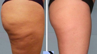 Trattamento anti-cellulite da fare a casa