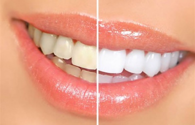 Denti gialli: 8 alimenti da evitare e modi per sbiancarli
