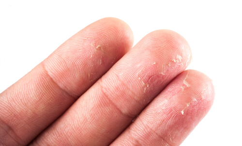 Eczema dita