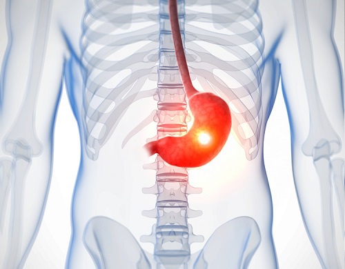 Intolleranza al lattosio