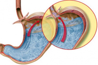 Malattia da reflusso gastroesofageo: 5 rimedi naturali