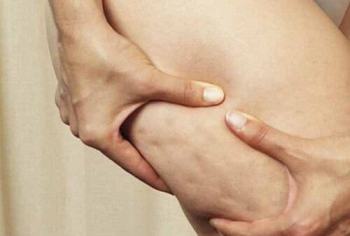 Alimenti che aumentano la cellulite