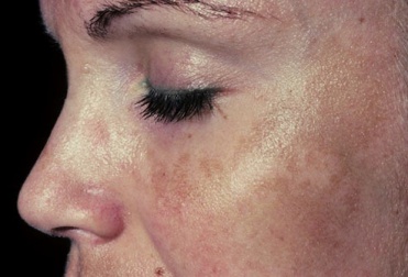 6 rimedi naturali per attenuare il melasma