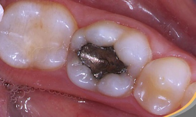 Rischi per la salute delle otturazioni di amalgama dentale