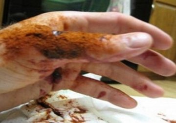 Fermare le emorragie con un gel, in soli 10 secondi