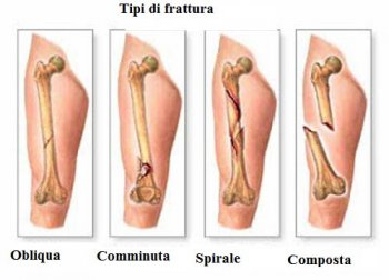 Tumore alle ossa primario: sintomi da conoscere