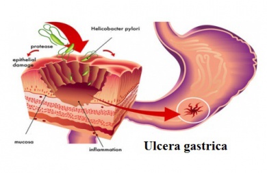 Helicobacter Pylori: rimedi naturali per combattere questo batterio