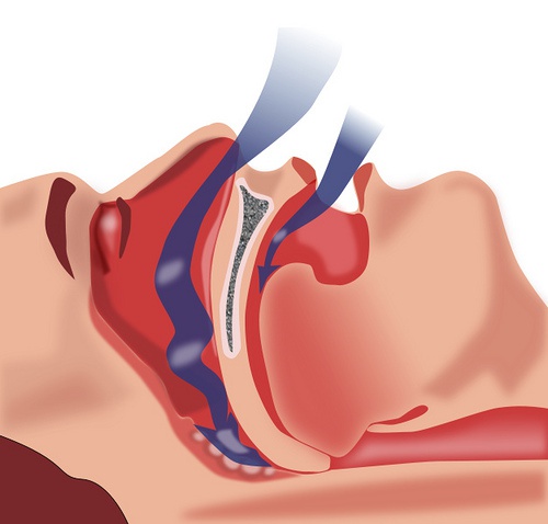 Apnea notturna