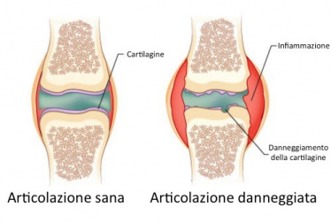Dolori dell’artrite: il perfetto rimedio naturale