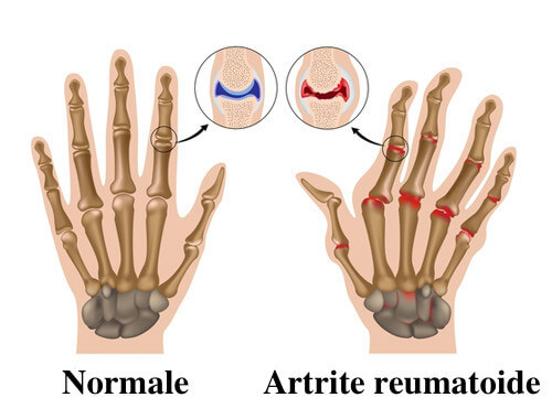 Artrite reumatoide: 7 consigli per alleviarla