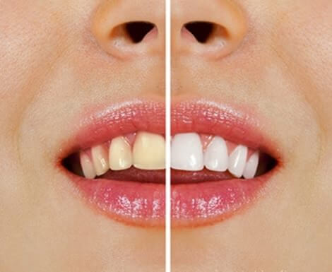 Alimenti che ingialliscono i denti. Cosa fare?