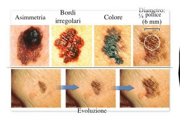 Melanoma: impariamo a identificare i primi sintomi