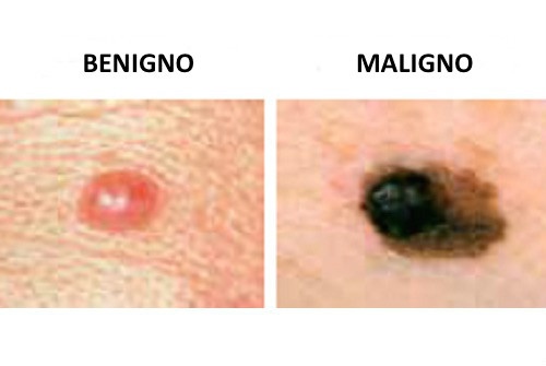 Confronto tra neo benigno e neo maligno