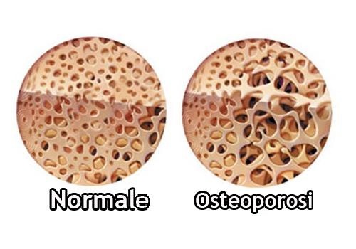 il dolore alle ossa può essere provocato dall'osteoporosi