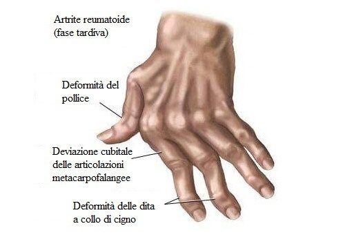 L'artrite alle mani.