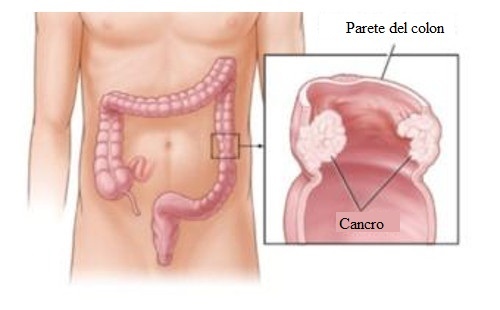 cancro al colon