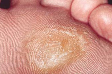 7 rimedi per i calli ai piedi da preparare a casa