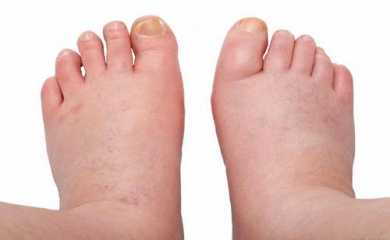 Sgonfiare caviglie, gambe e piedi con rimedi naturali