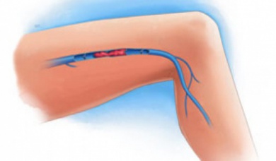 Trombosi venosa alle gambe: ecco i sintomi