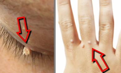 Rimedi casalinghi efficaci per eliminare le verruche