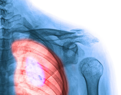 I sintomi del cancro al polmone: imparate a riconoscerli