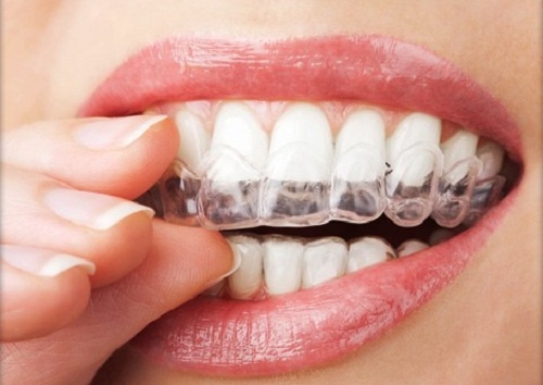 Bruxismo strategie per smettere di digrignare i denti