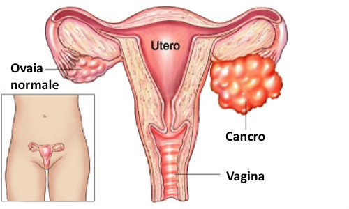 cancro alle ovaie