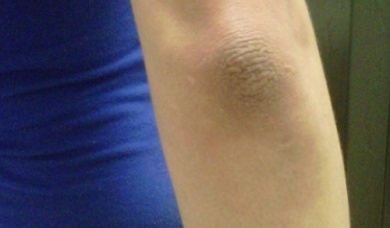 Ginocchia e gomiti scuri, cosa fare