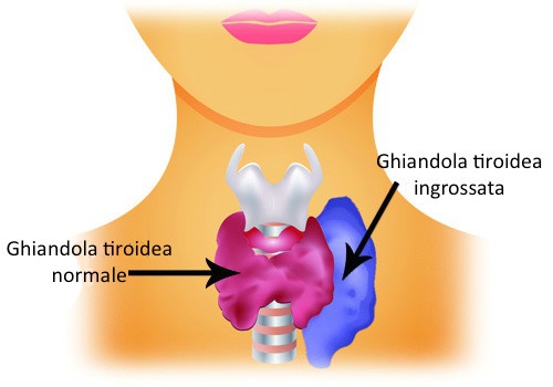 Disturbi alla tiroide - Ipotiroidismo