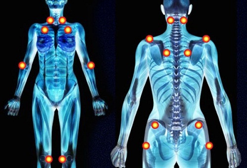 Fibromialgia