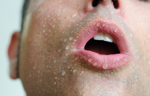 Sudorazione eccessiva