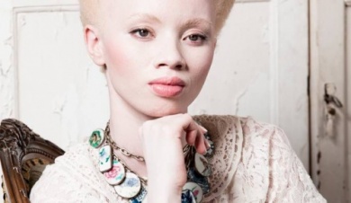 Albinismo: il commovente caso di Thando Hopa