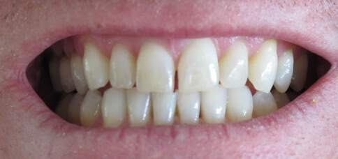 Digrignare i denti