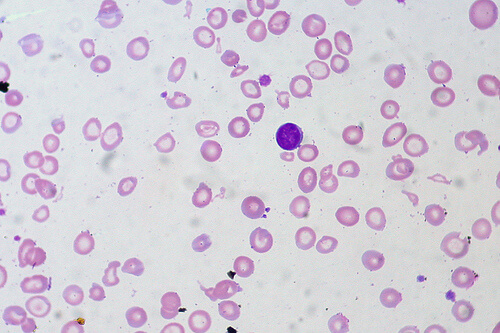 Diversi tipi di anemia