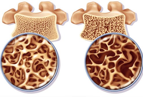 osteoporosi