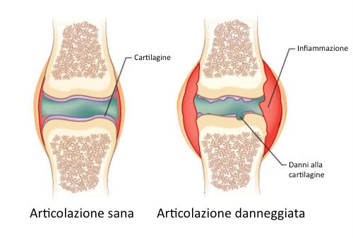 Artrite1