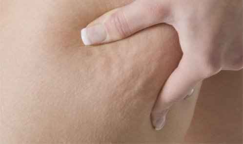 Cellulite