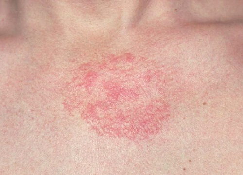 5 rimedi contro la dermatite da preparare in casa