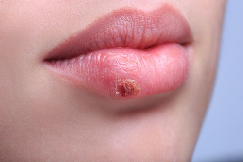 Herpes labbra