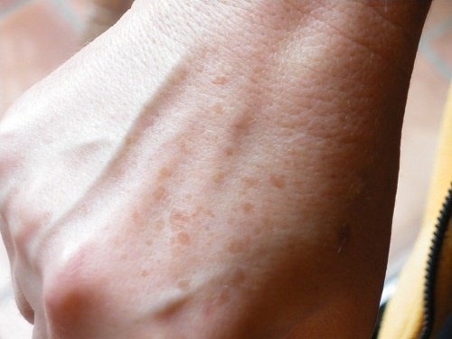 rimedi naturali per eliminare le macchie scure della pelle