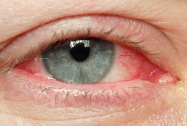 Occhi irritati: i migliori rimedi naturali