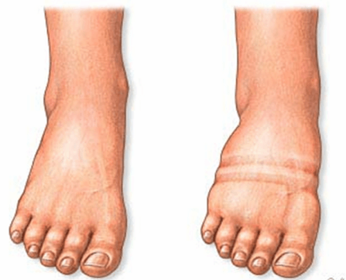 Le cause del gonfiore ai piedi sono molteplici