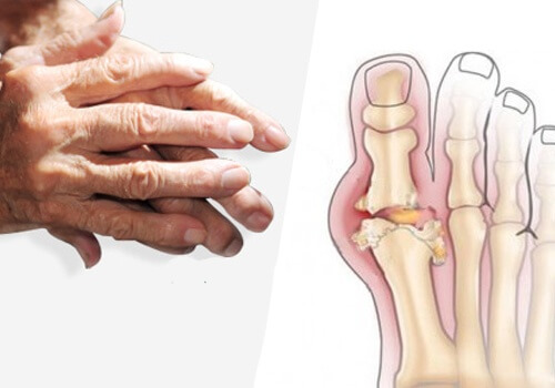 artrite alle mani e piedi