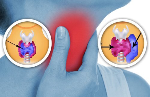 la tiroide e i suoi disturbi