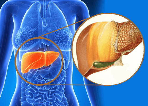 Cos'è il fegato grasso e come si cura