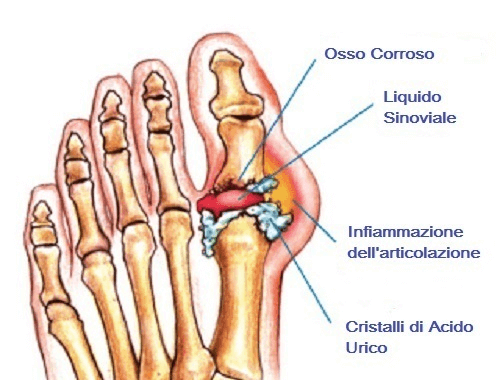 Curare la gotta con questo potente rimedio naturale