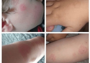 Malattia di Lyme: attenzione alle zecche