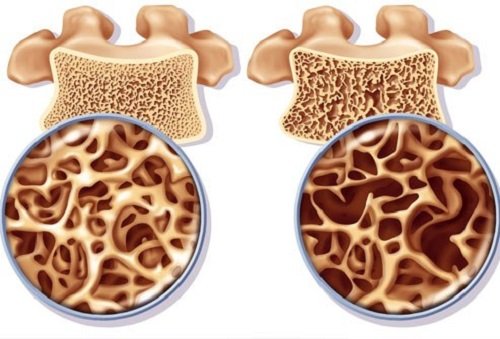 osteoporosi e prevenzione