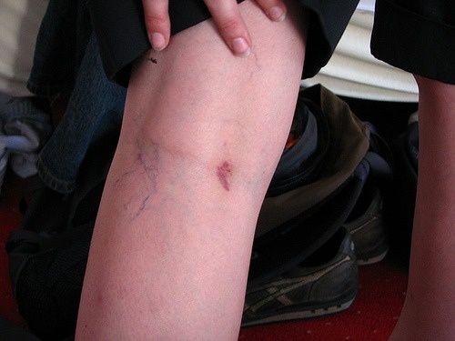 ridurre il rischio di vene varicose non usare jeans attillati