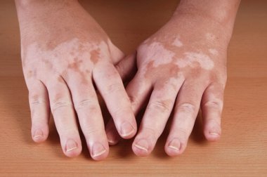 5 rimedi da fare in casa contro la vitiligine